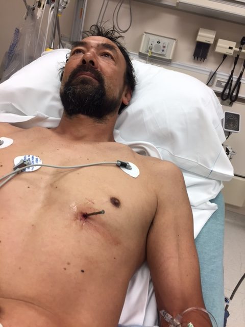 A 3.5-inch framing nail hit Doug Bergeson in the heart.